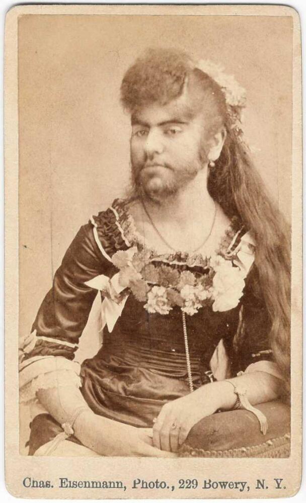 Hirsutism.jpg.jpeg